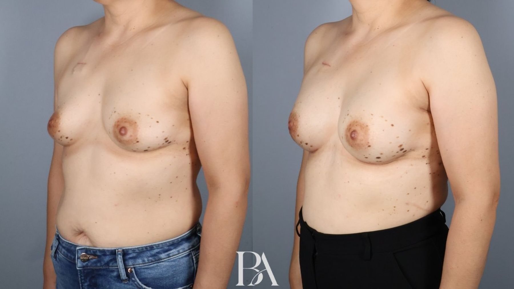 Direct-to-Implant Reconstruction before and after — side view, Dr. Beina Azadgoli, Beverly Hills