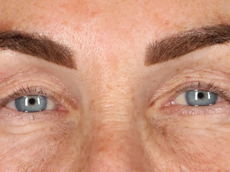 Before — Upper Blepharoplasty