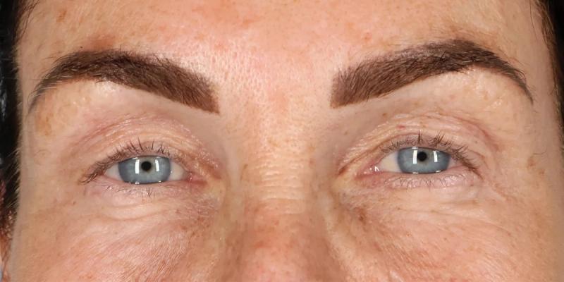 Before — Upper Blepharoplasty