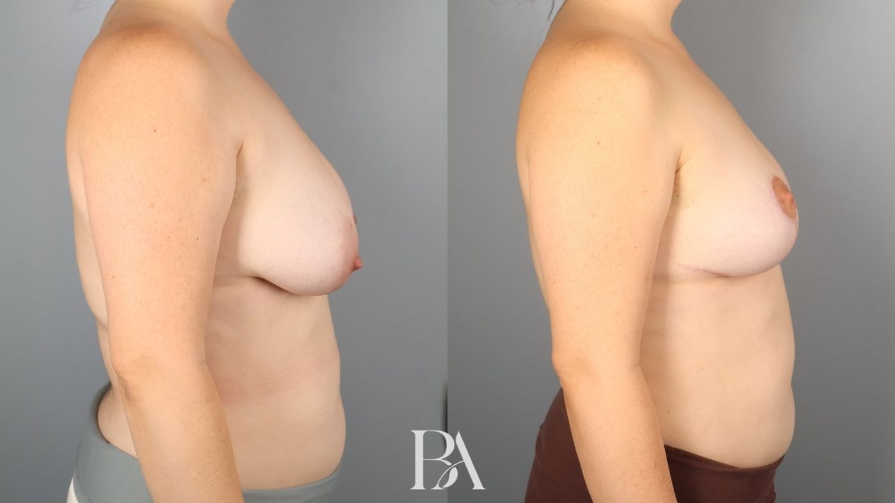 Breast lift before and after — side view, Dr. Beina Azadgoli, Beverly Hills