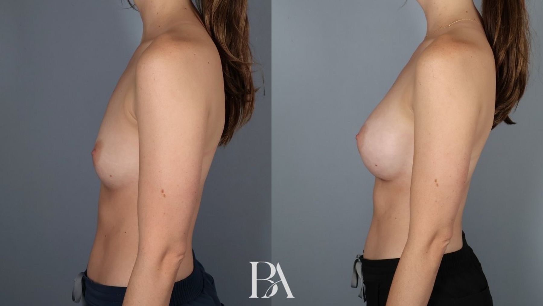Breast augmentation before and after — side view, Dr. Beina Azadgoli, Beverly Hills