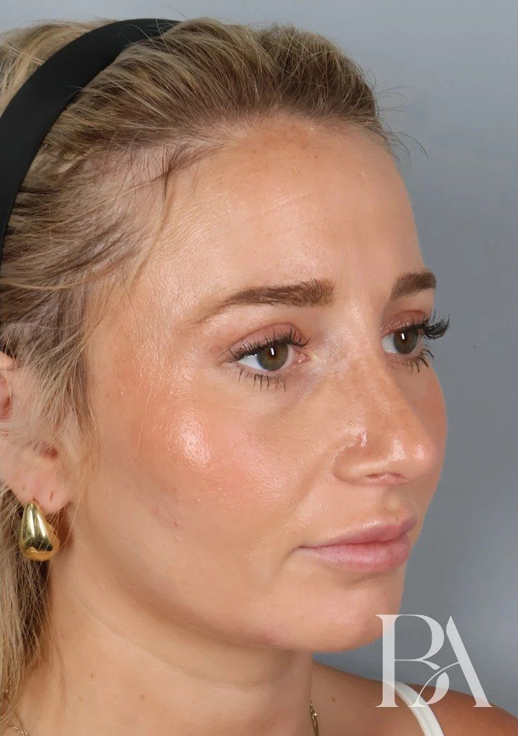 After — Rhinoplasty