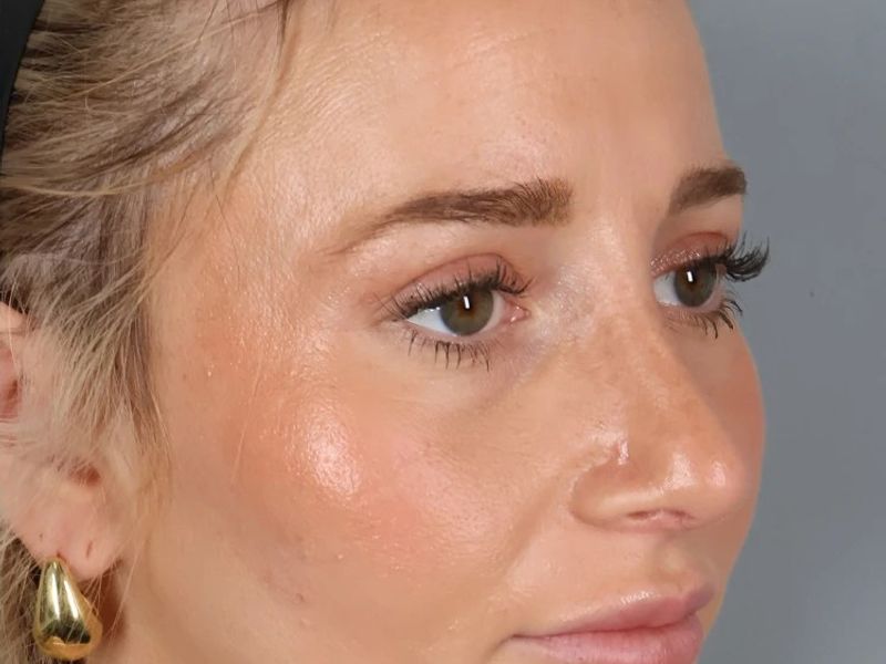 After — Rhinoplasty