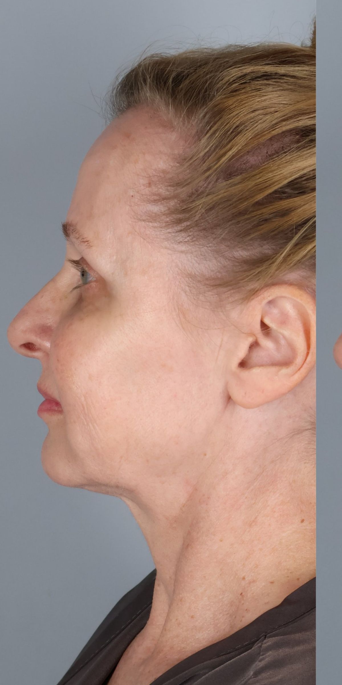 Face/neck lift before — side view, Dr. Beina Azadgoli, Beverly Hills