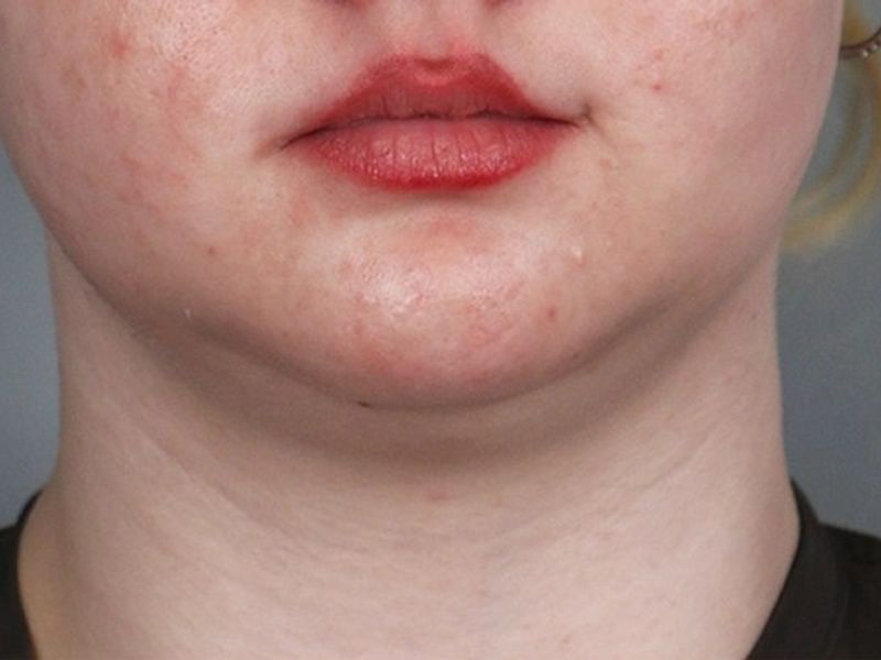 Before — Submental Liposuction
