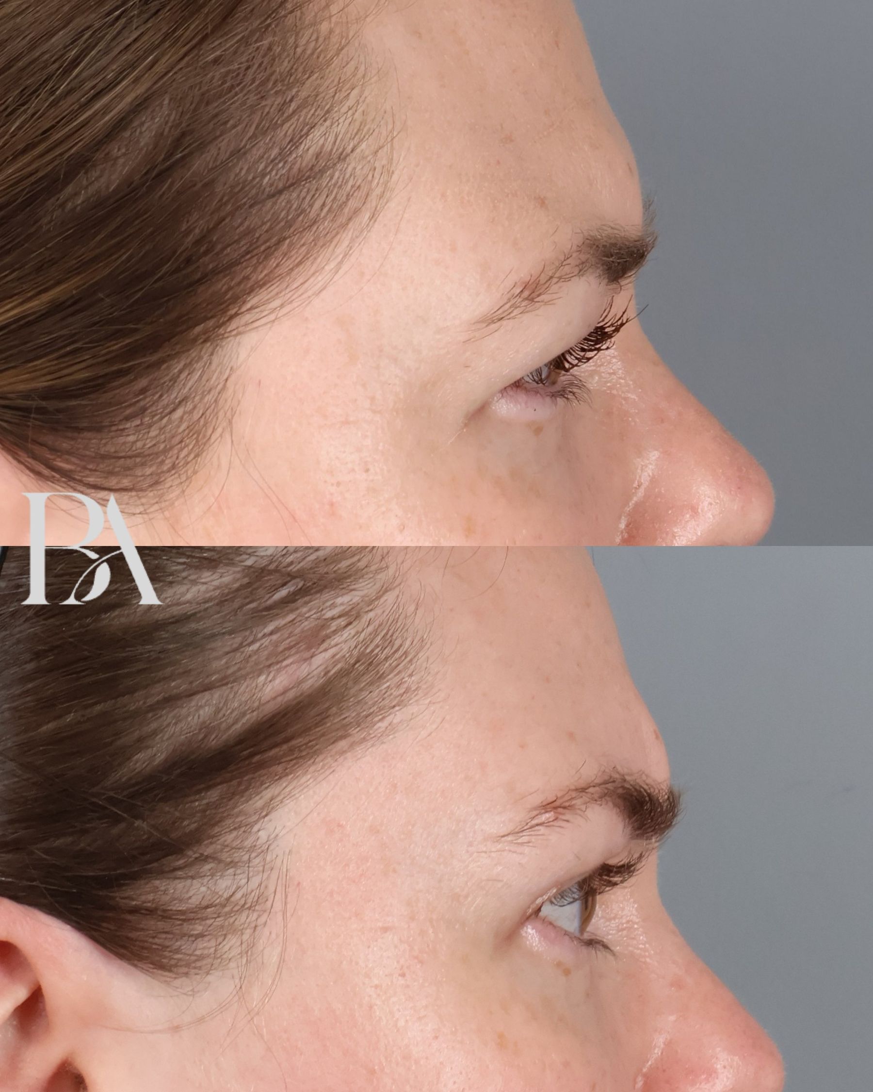 Upper Blepharoplasty before and after — side view, Dr. Beina Azadgoli, Beverly Hills
