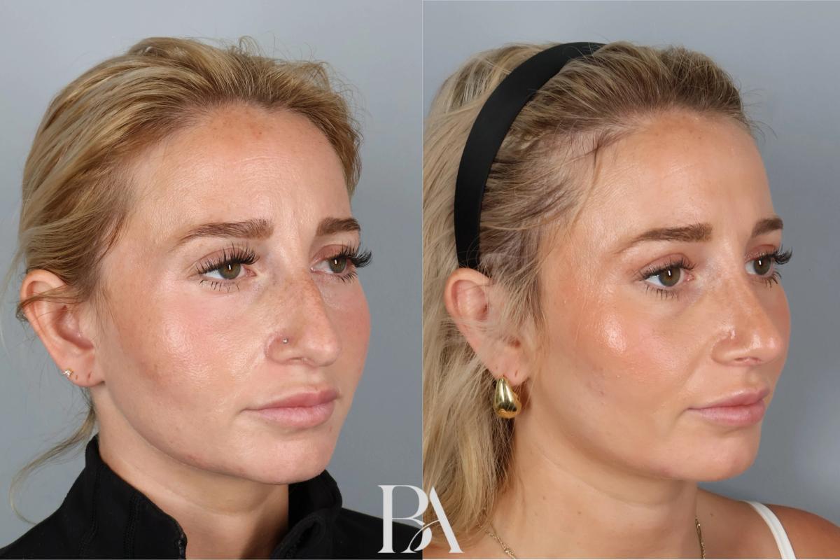 Before and after — Rhinoplasty