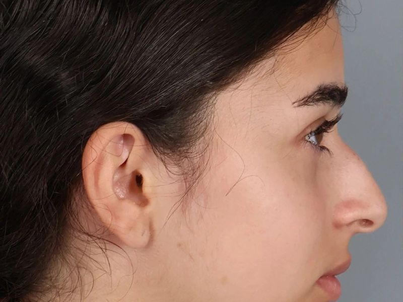 Before — Rhinoplasty