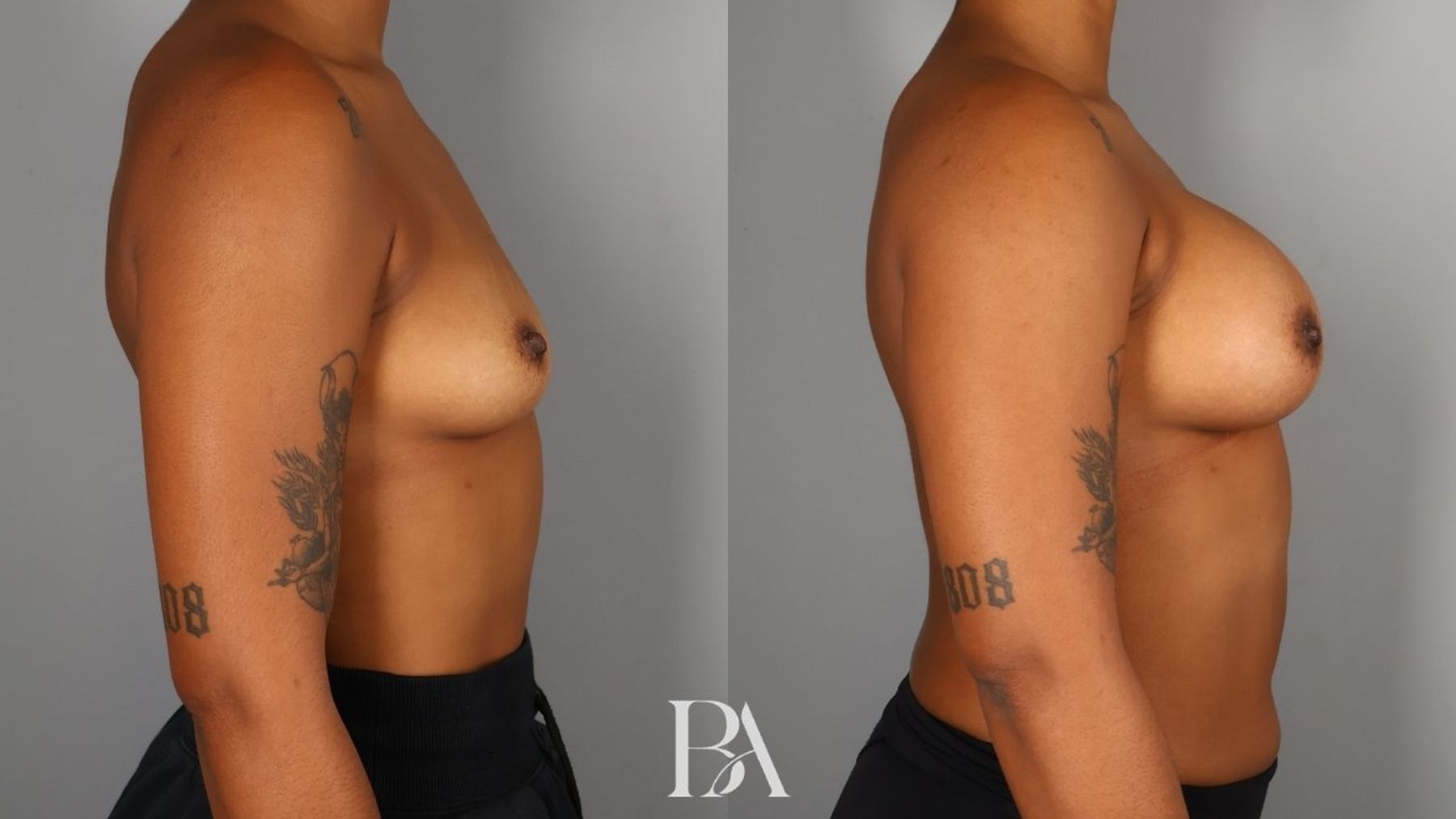Breast augmentation before and after — side view, Dr. Beina Azadgoli, Beverly Hills