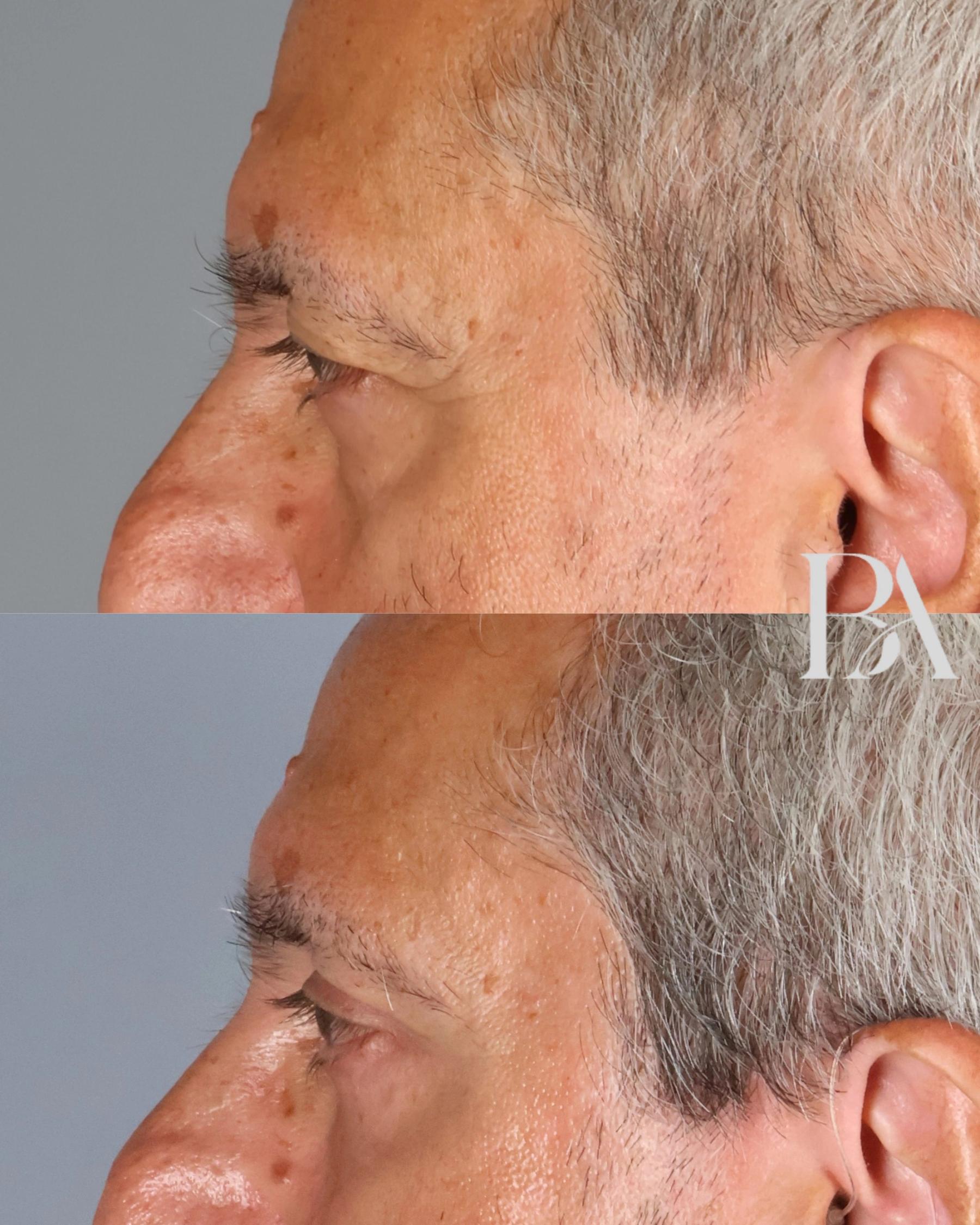 Upper Blepharoplasty before and after — side view, Dr. Beina Azadgoli, Beverly Hills