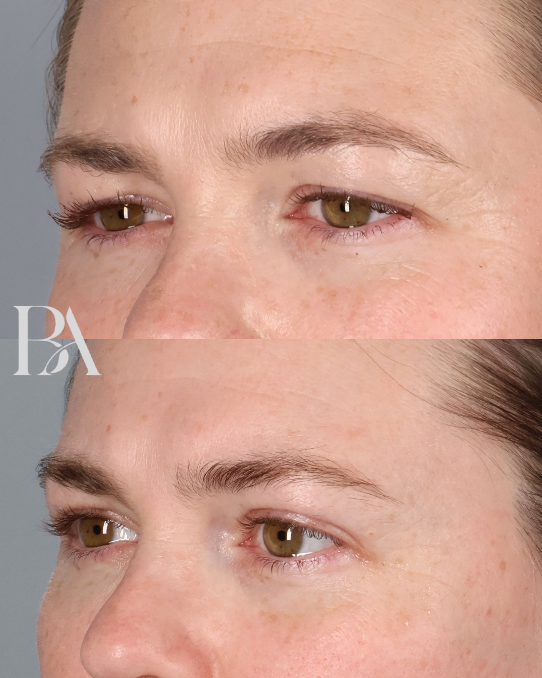 Upper Blepharoplasty before and after — three-quarter view, Dr. Beina Azadgoli, Beverly Hills