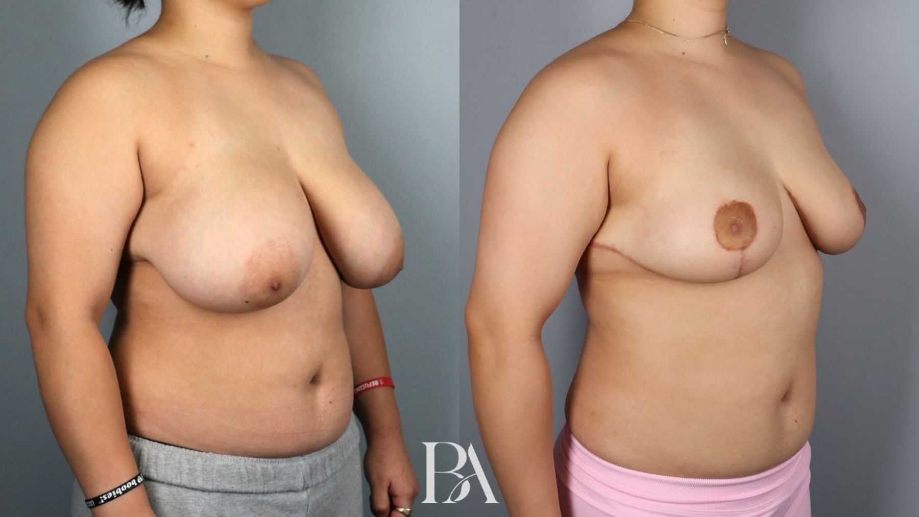 Breast reduction before and after — oblique view, Dr. Beina Azadgoli, Beverly Hills