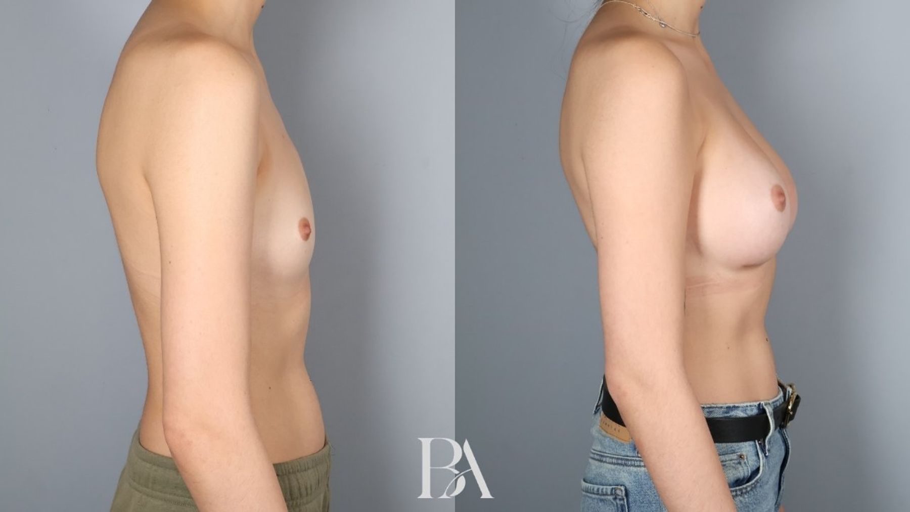 Breast augmentation before and after — side view, Dr. Beina Azadgoli, Beverly Hills