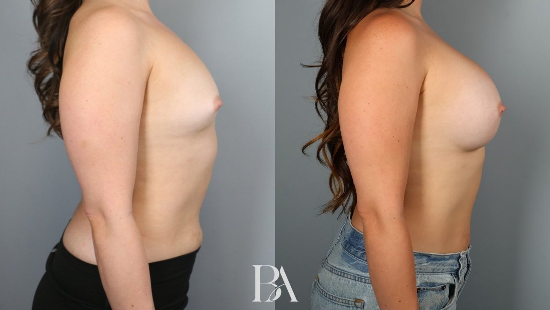 Breast augmentation before and after — side view, Dr. Beina Azadgoli, Beverly Hills
