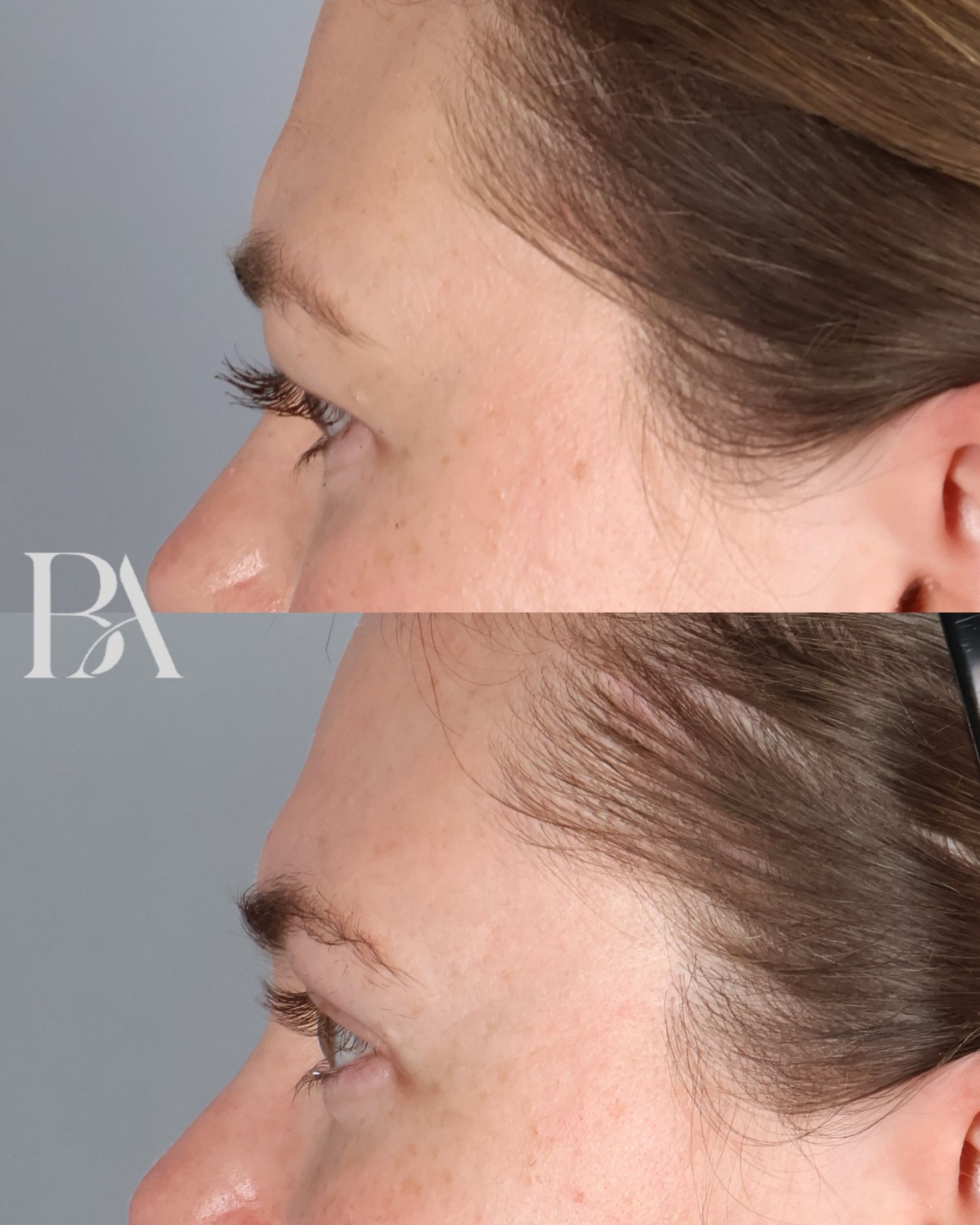Upper Blepharoplasty before and after — side view, Dr. Beina Azadgoli, Beverly Hills