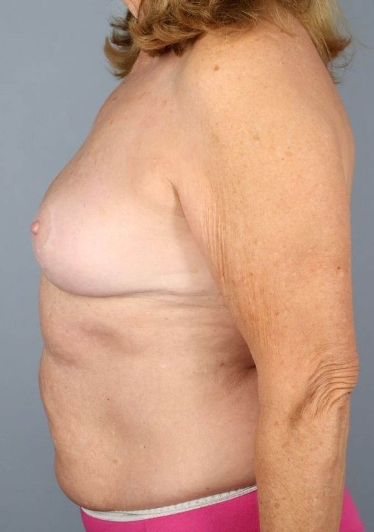 Breast implant removal after — side view, Dr. Beina Azadgoli, Beverly Hills
