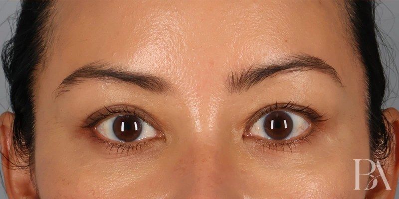 After — Upper Blepharoplasty