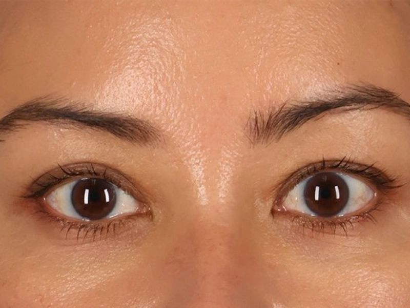 After — Upper Blepharoplasty