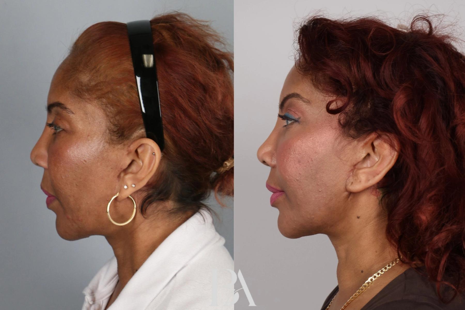 Rhinoplasty before and after — side view, Dr. Beina Azadgoli, Beverly Hills