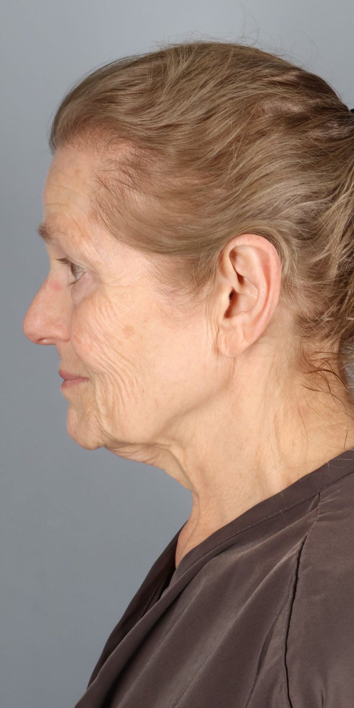 Face/neck lift before — side view, Dr. Beina Azadgoli, Beverly Hills