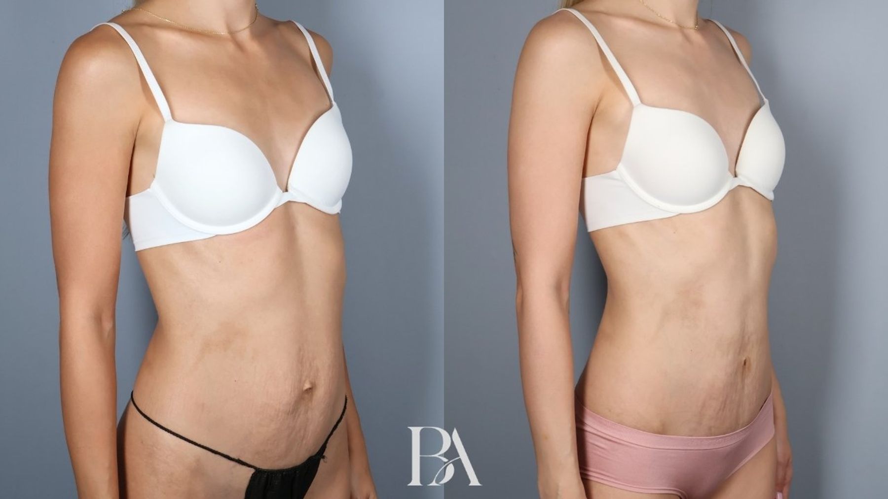 Tummy tuck before and after — oblique view, Dr. Beina Azadgoli, Beverly Hills