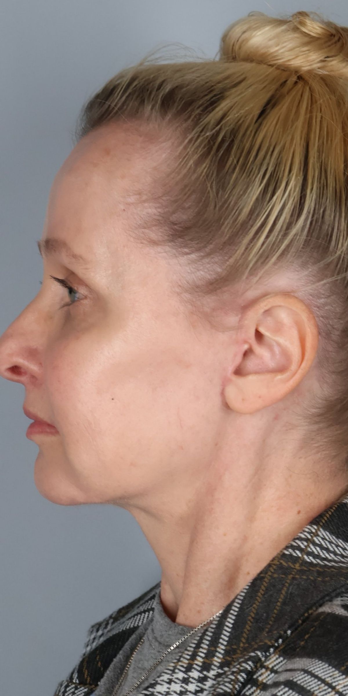 Face/neck lift after — side view, Dr. Beina Azadgoli, Beverly Hills