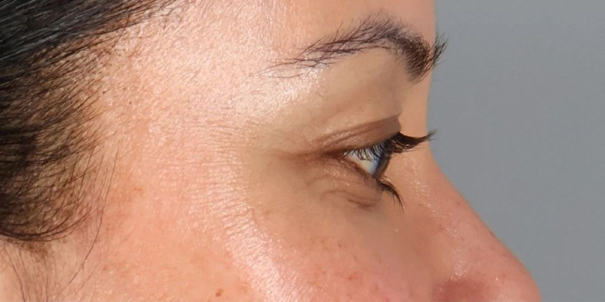 Case 2001 — Oblique before