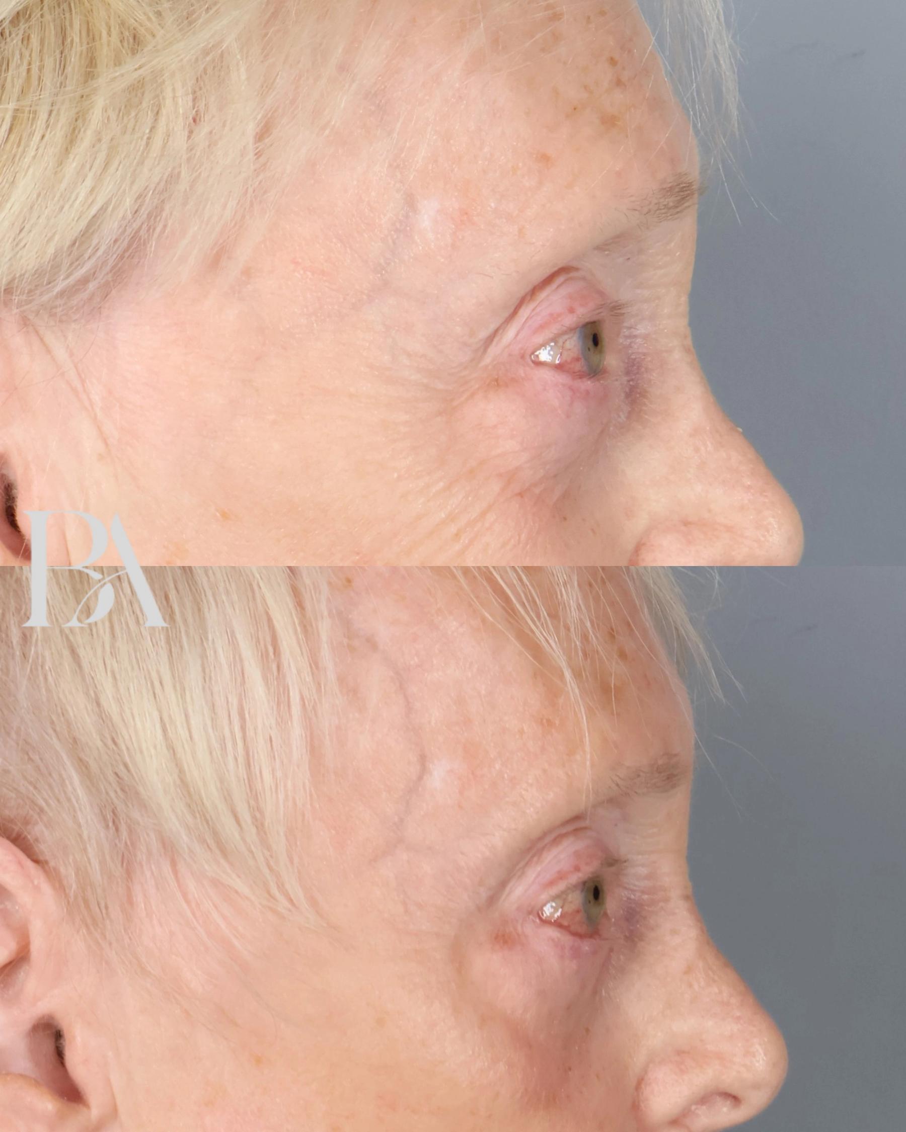 Lower Blepharoplasty before and after — side view, Dr. Beina Azadgoli, Beverly Hills