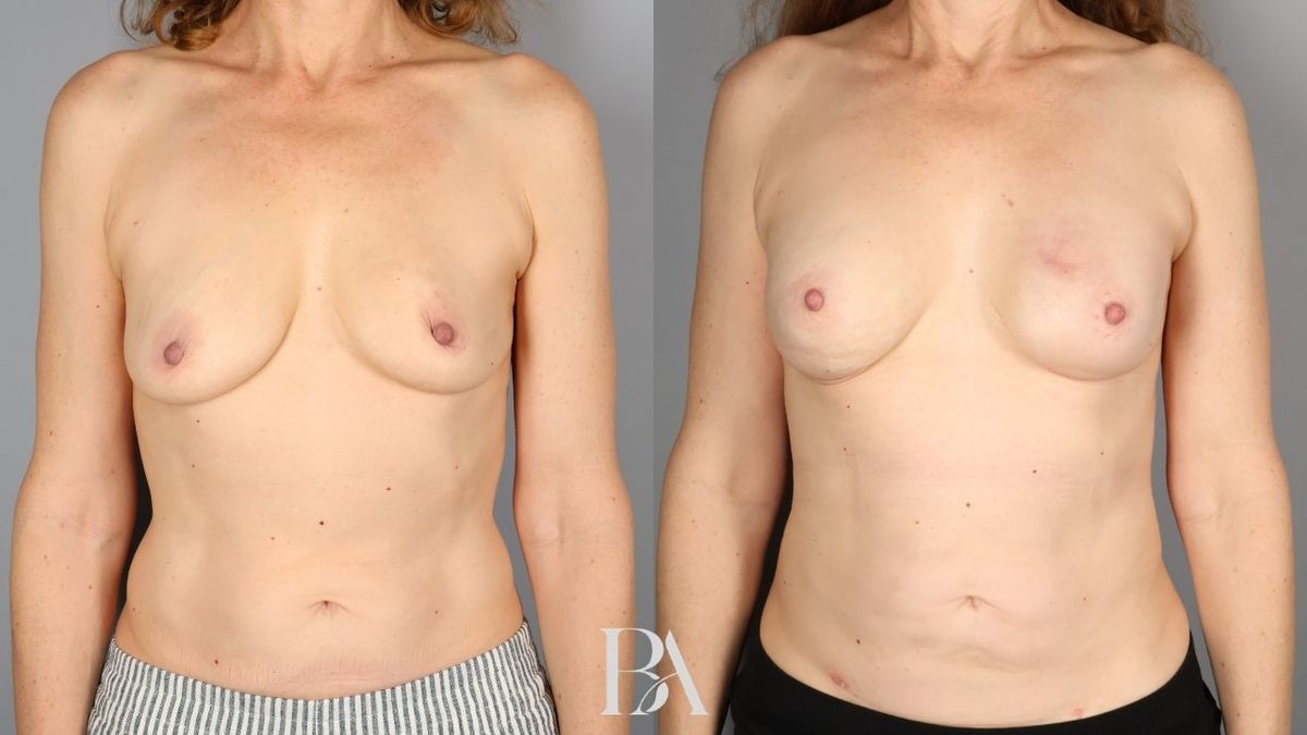 Before and after — Direct-to-Implant Reconstruction