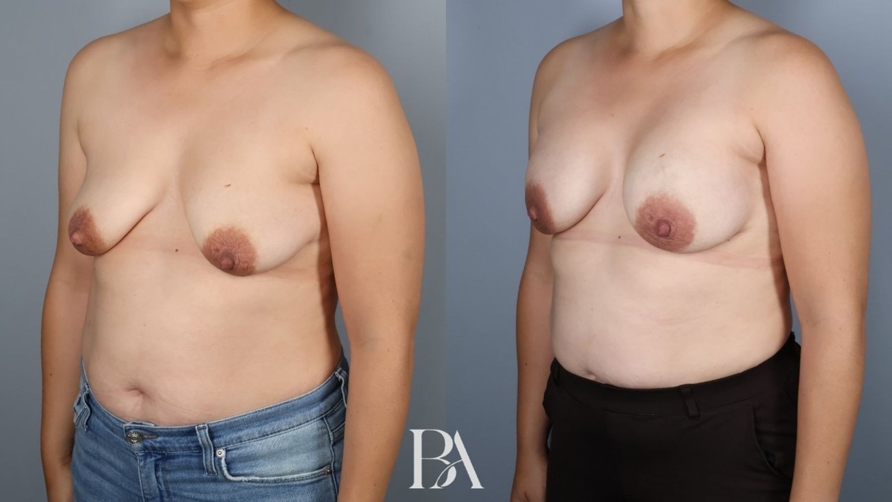 Direct-to-Implant Reconstruction before and after — three-quarter view, Dr. Beina Azadgoli, Beverly Hills