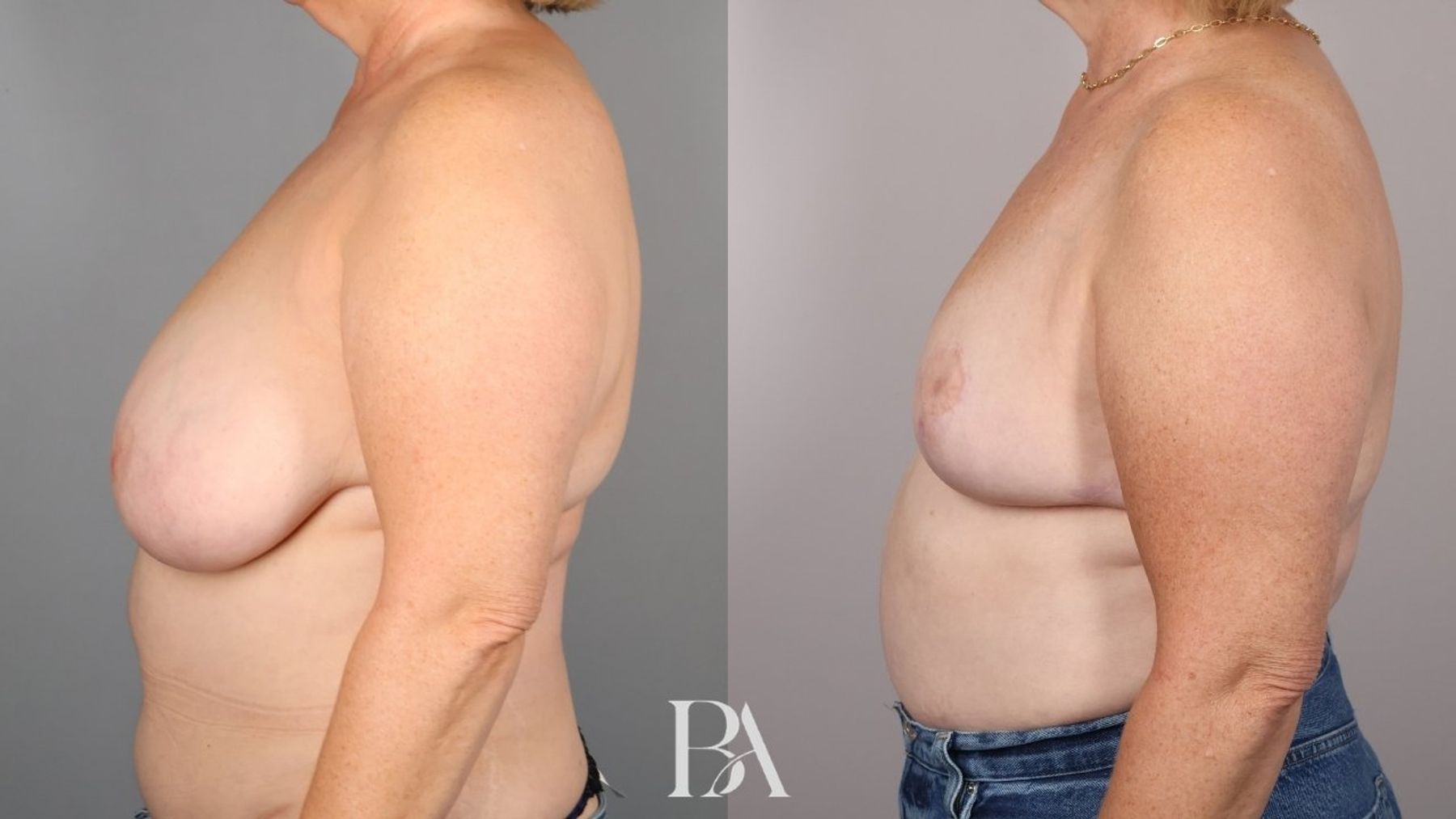 Breast reduction before and after — side view, Dr. Beina Azadgoli, Beverly Hills