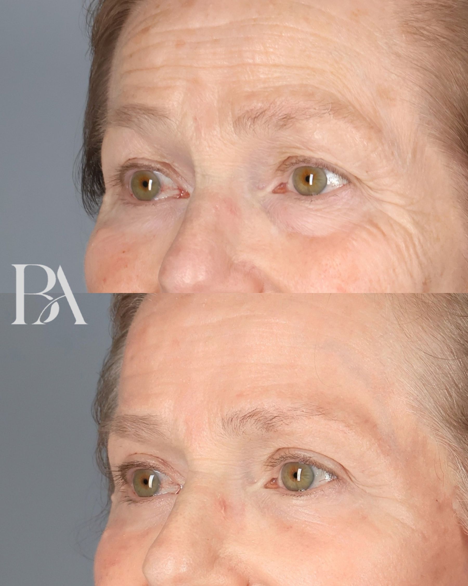 Upper Blepharoplasty before and after — oblique view, Dr. Beina Azadgoli, Beverly Hills