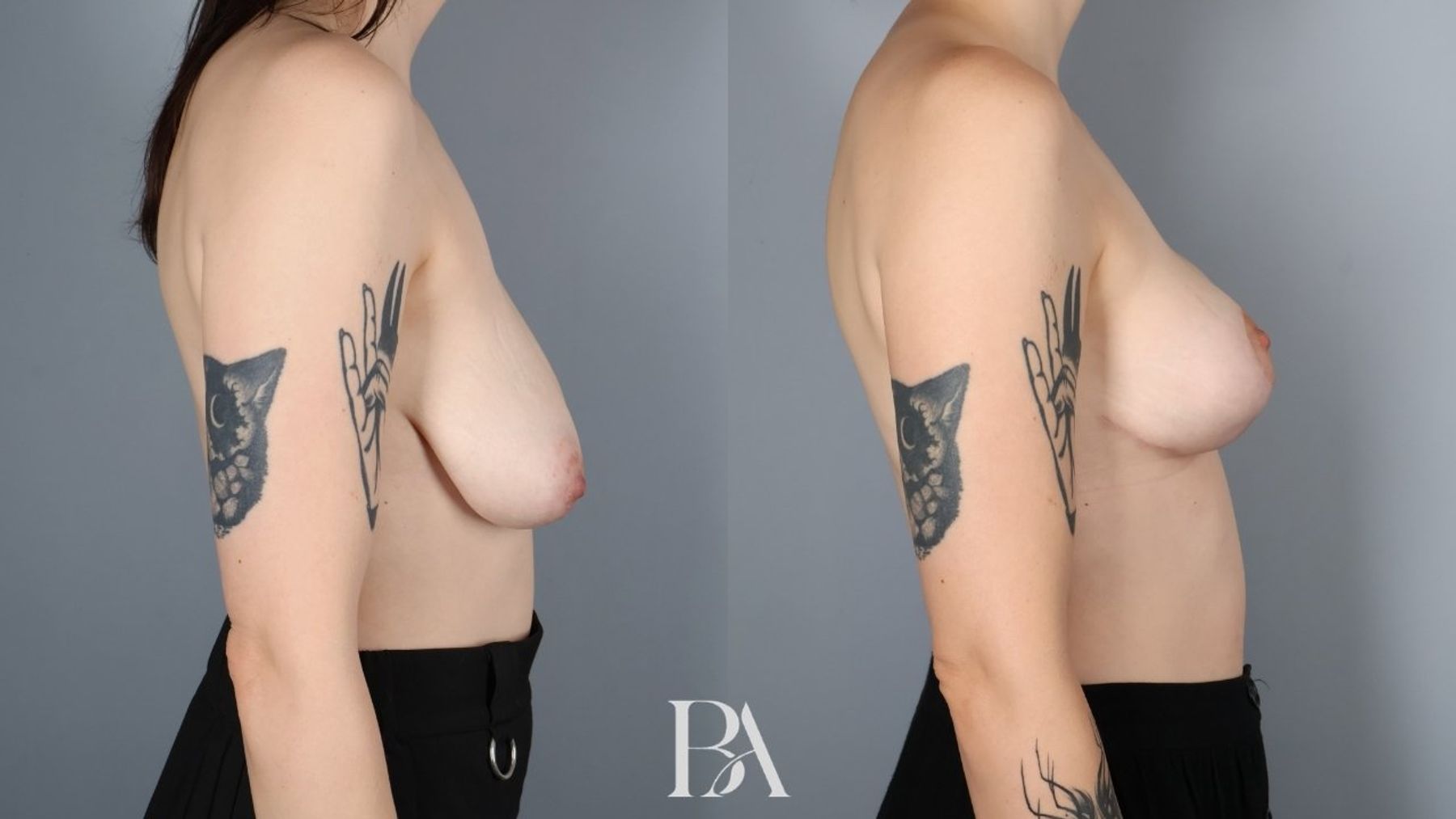 Breast lift before and after — side view, Dr. Beina Azadgoli, Beverly Hills