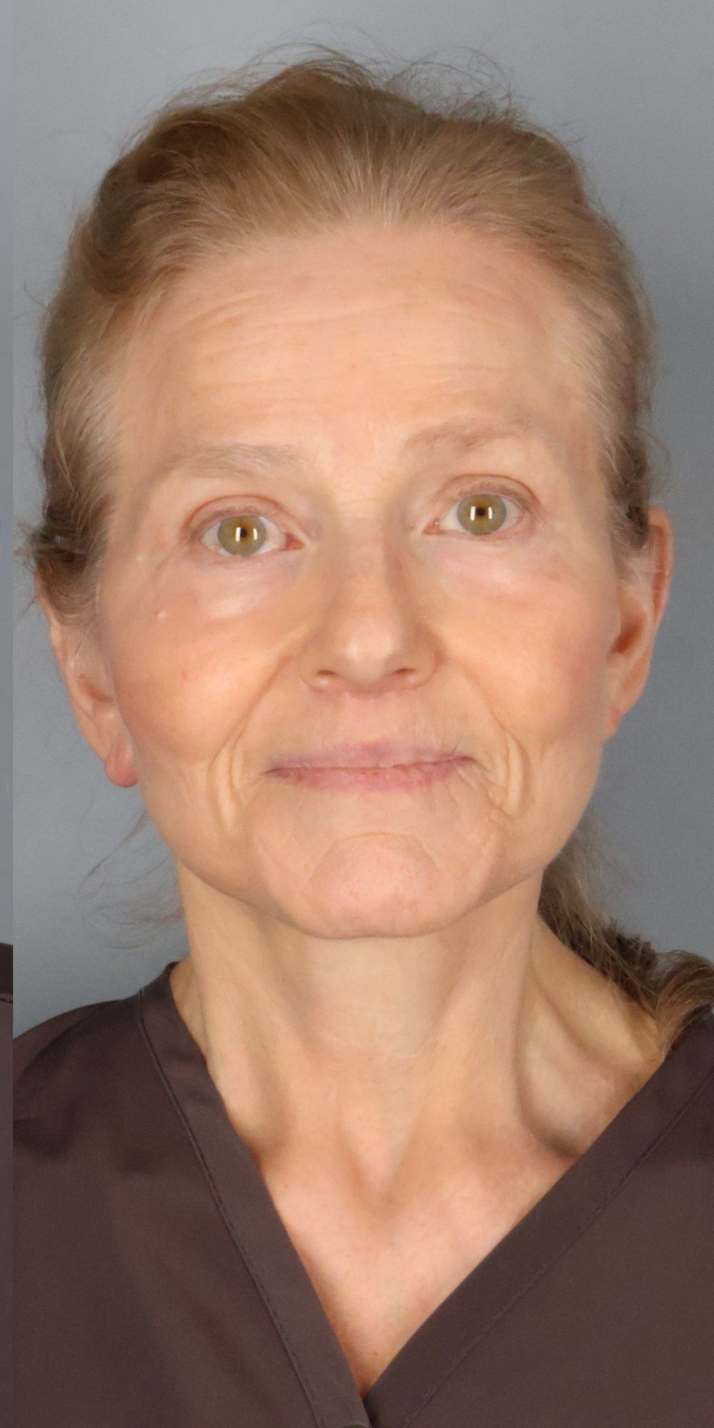 After — Face/Neck Lift