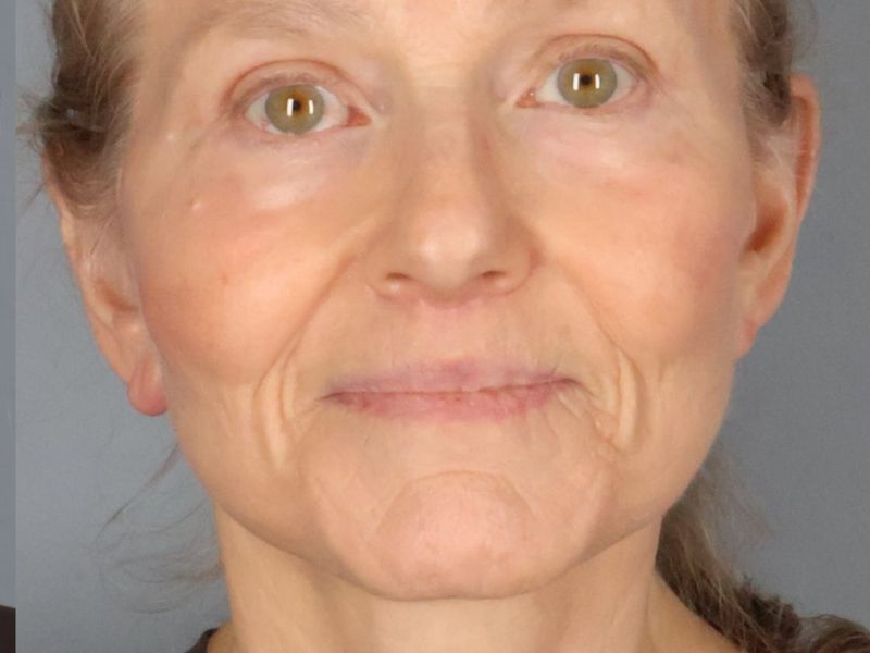 After — Face/Neck Lift