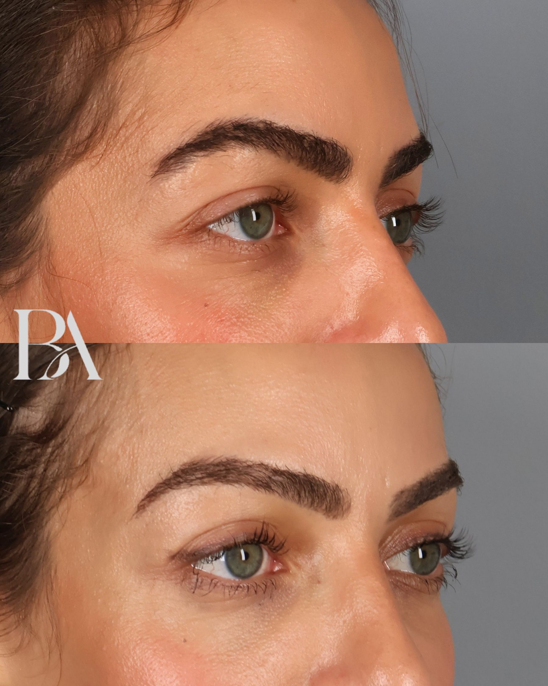 Upper Blepharoplasty before and after — oblique view, Dr. Beina Azadgoli, Beverly Hills