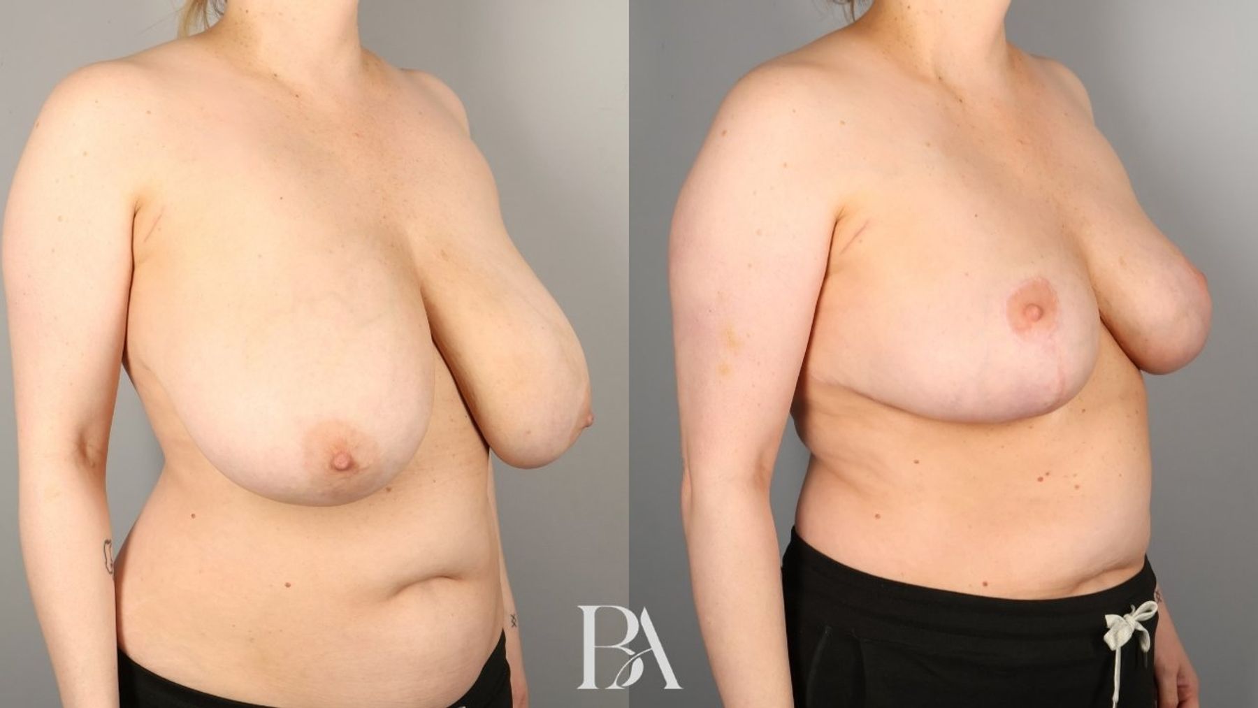 Oncoplastic Reduction before and after — oblique view, Dr. Beina Azadgoli, Beverly Hills