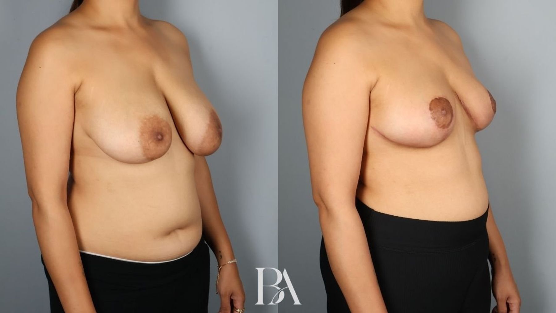 Breast reduction before and after — oblique view, Dr. Beina Azadgoli, Beverly Hills