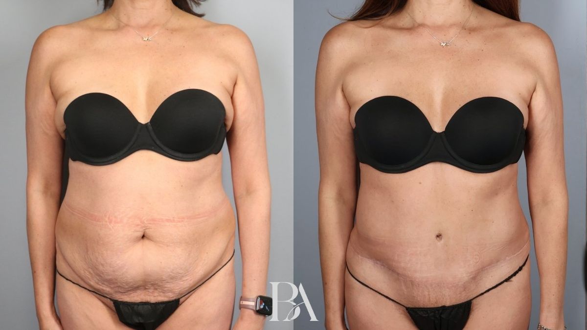Before and after — Tummy Tuck (Abdominoplasty)