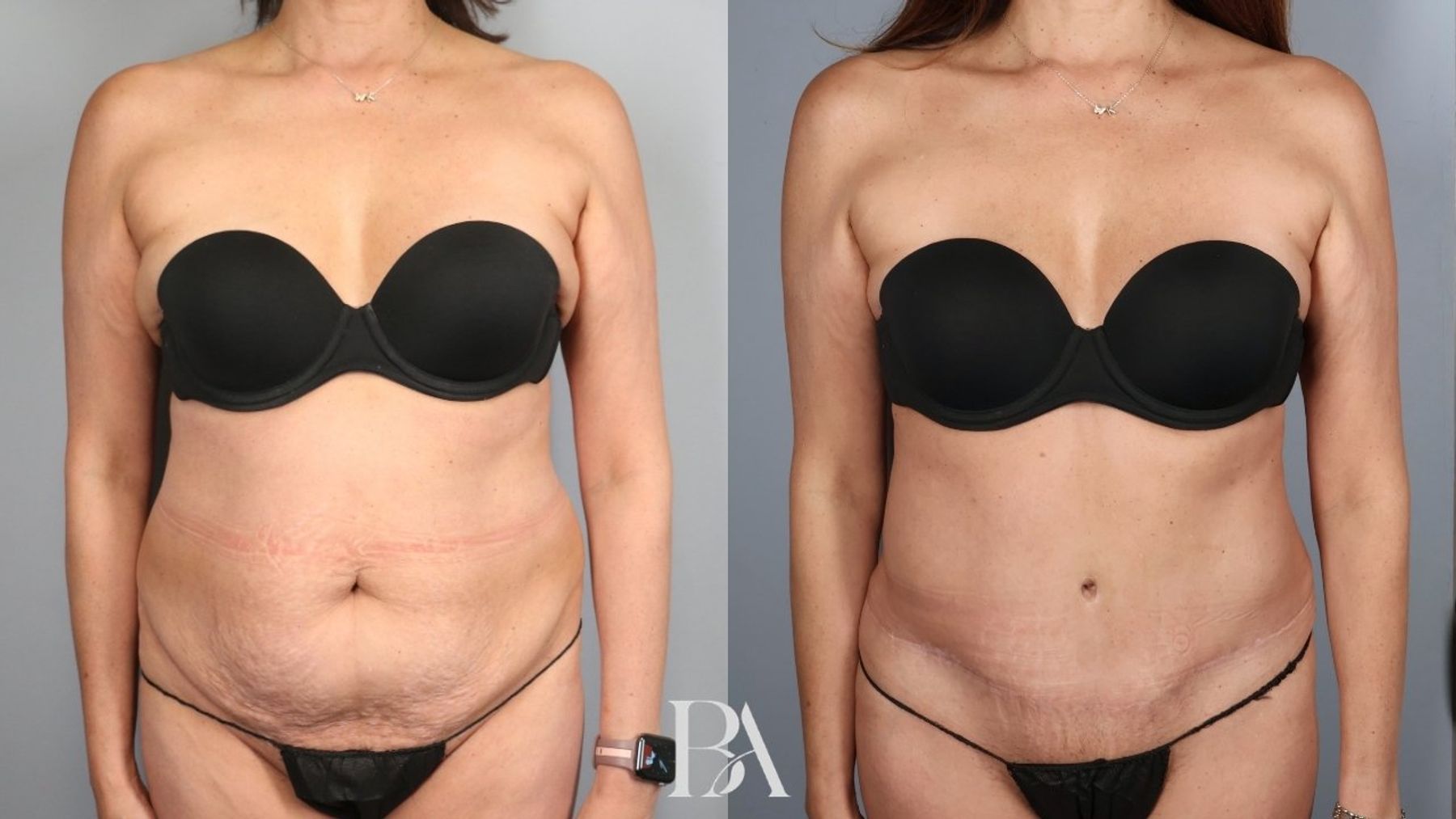 Tummy tuck before and after — front view, Dr. Beina Azadgoli, Beverly Hills