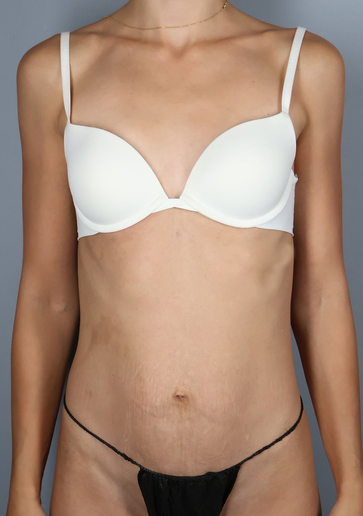 Rectus diastasis repair before — front view, Dr. Beina Azadgoli, Beverly Hills