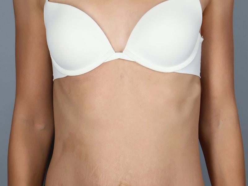 Before — Tummy Tuck (Abdominoplasty)