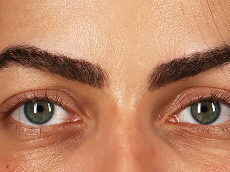 Before — Upper Blepharoplasty