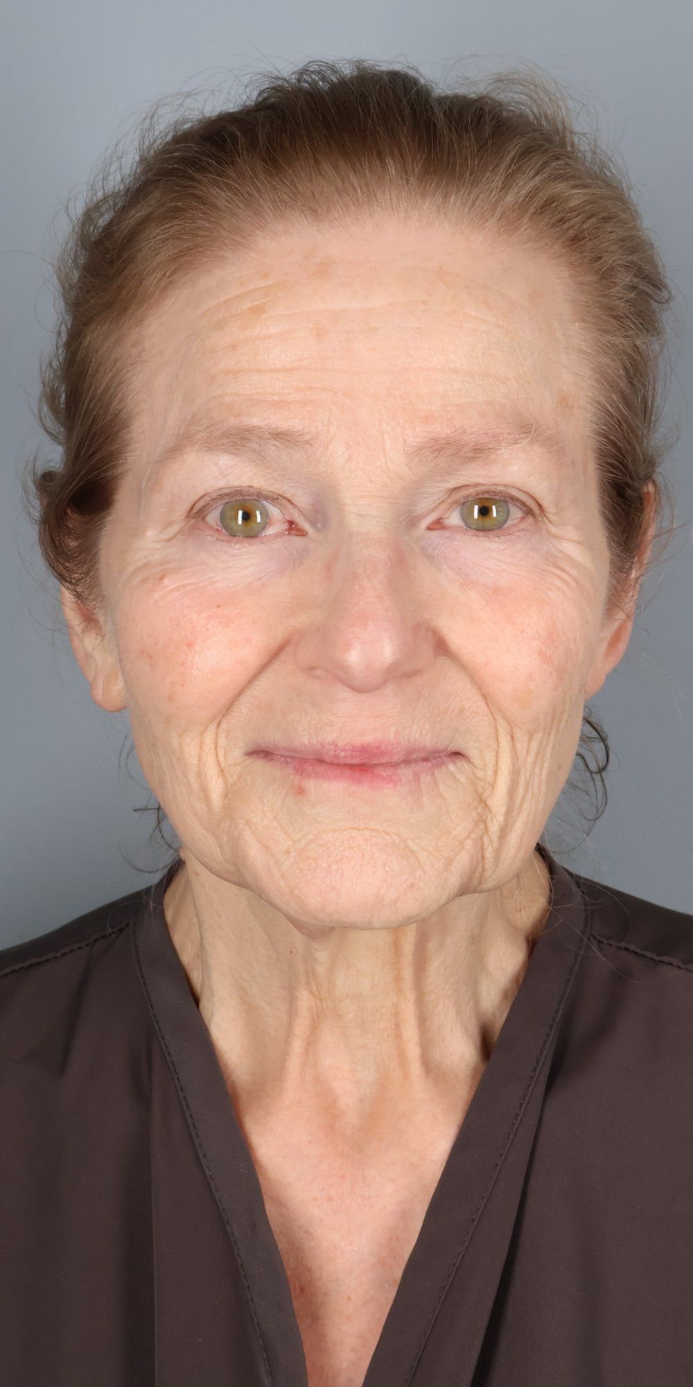 Before — Face/Neck Lift