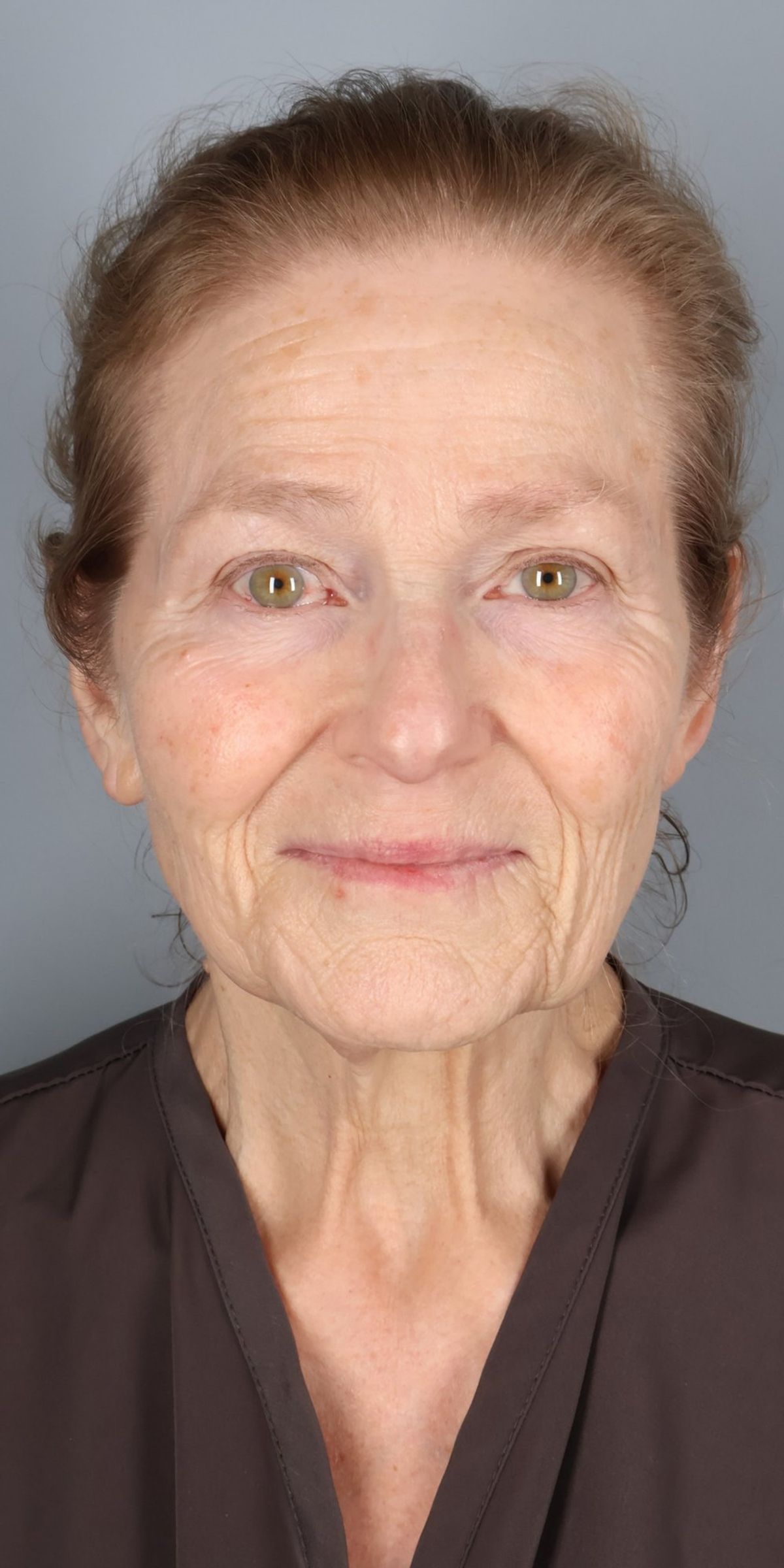 Face/neck lift before — front view, Dr. Beina Azadgoli, Beverly Hills