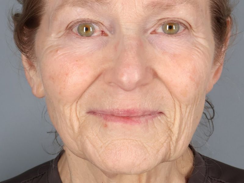 Before — Face/Neck Lift