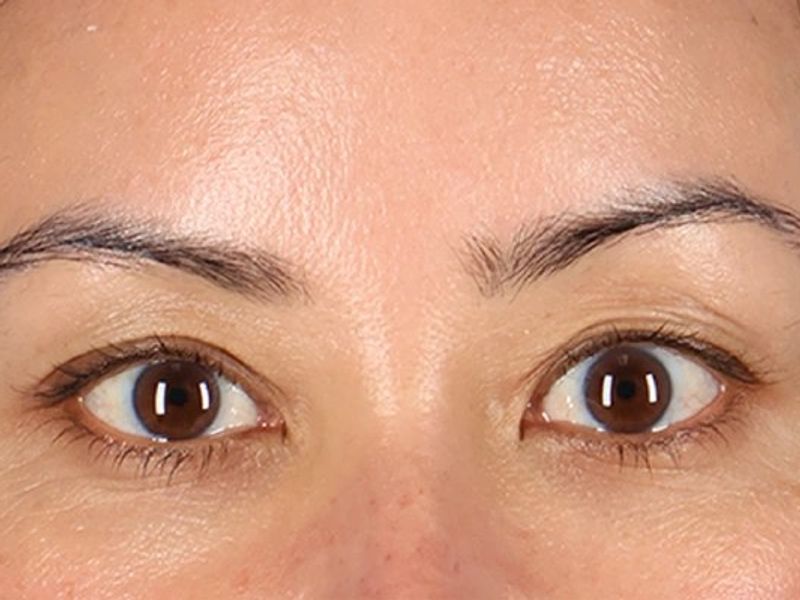 Before — Upper Blepharoplasty