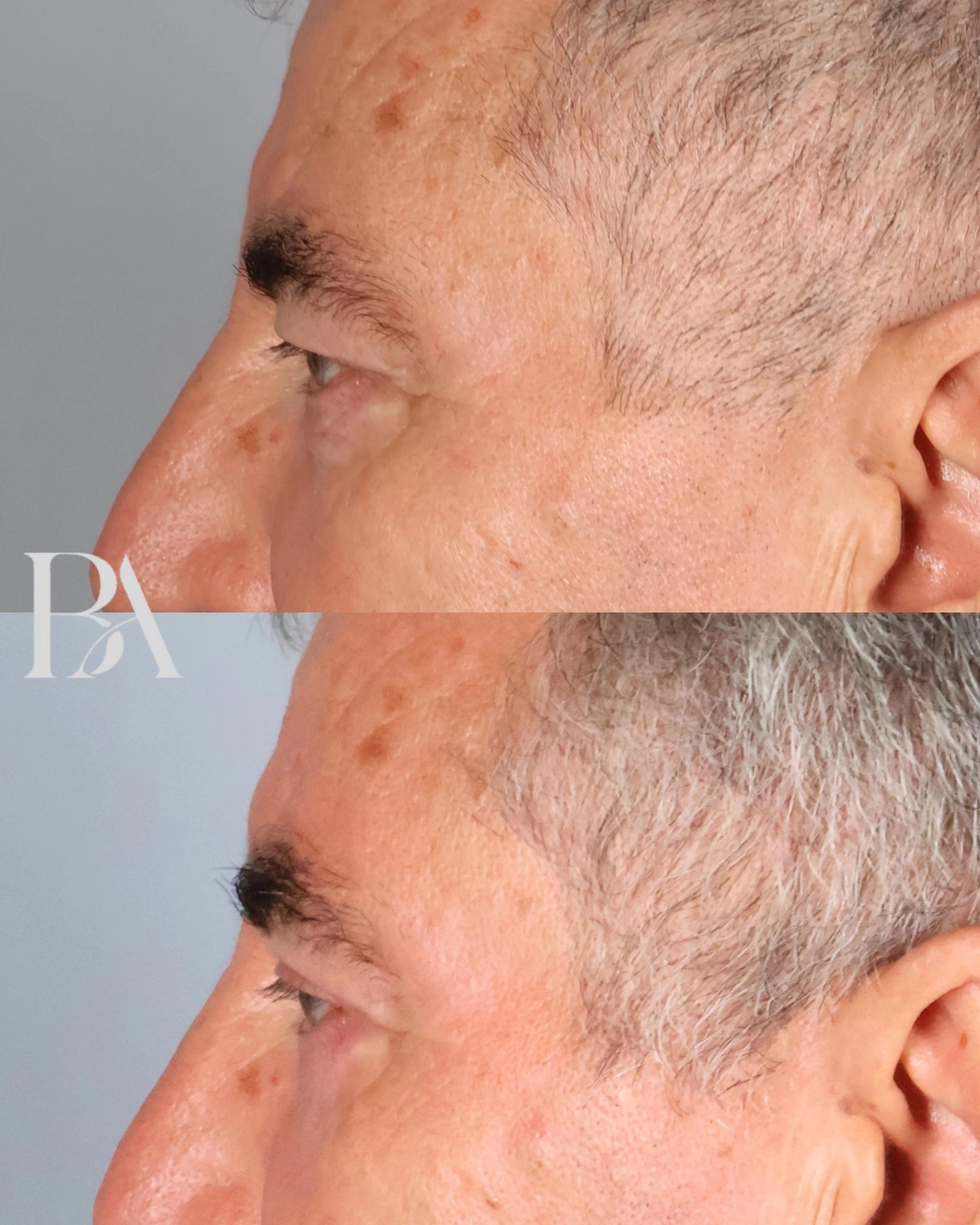 Upper Blepharoplasty before and after — side view, Dr. Beina Azadgoli, Beverly Hills