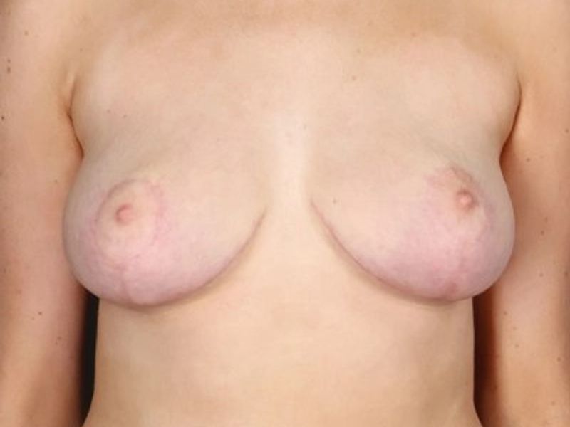 After — Breast Lift (Mastopexy)