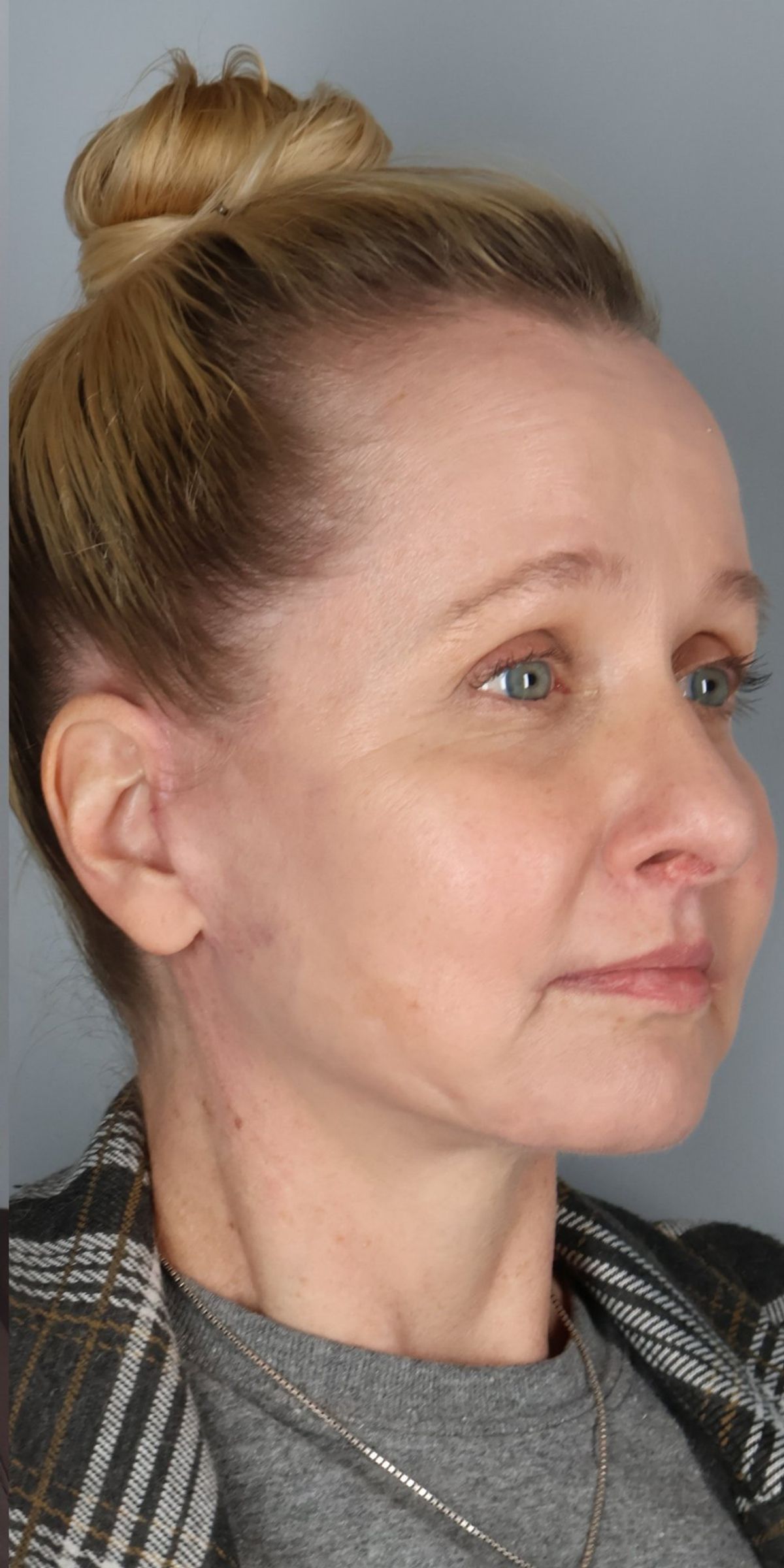 Face/neck lift after — oblique view, Dr. Beina Azadgoli, Beverly Hills
